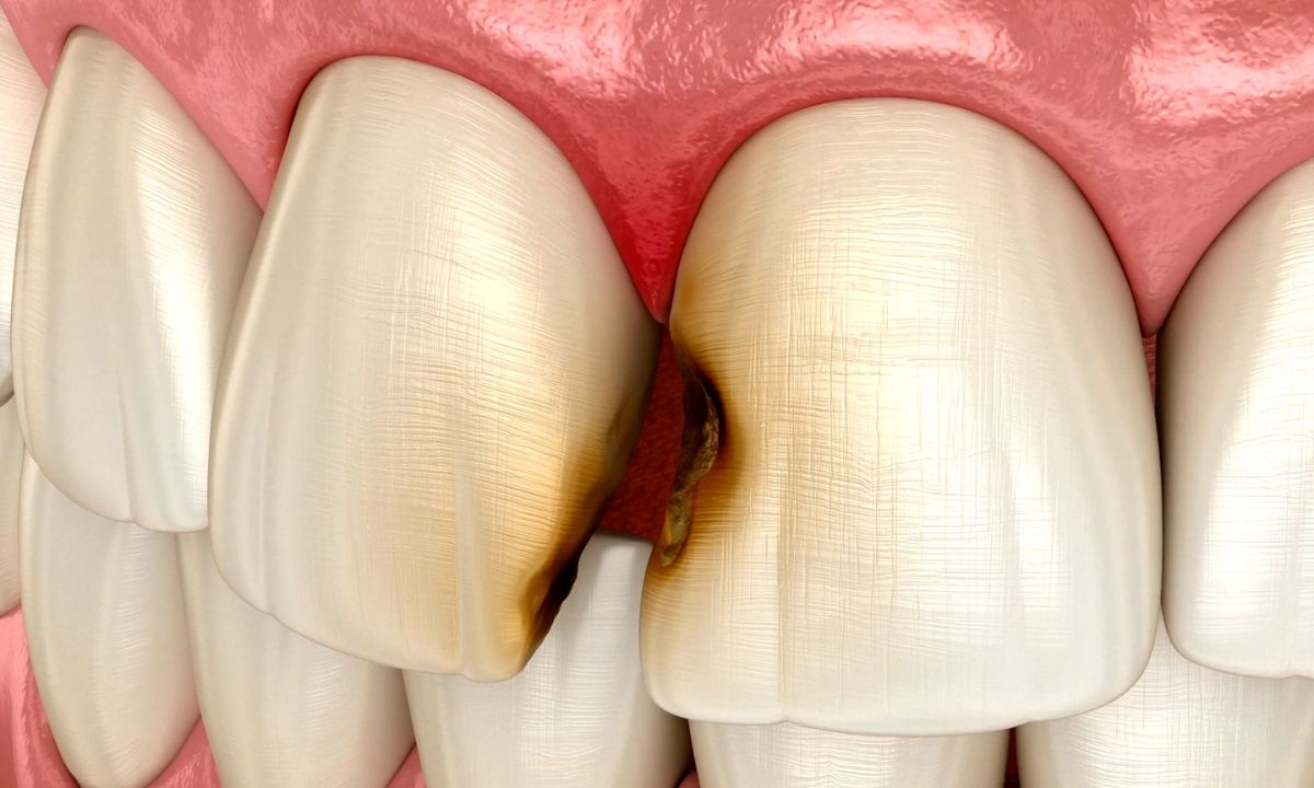 prikaz karijesa na prednjim zubima, ilustrovano