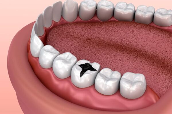 ilustrovani prikaz karijesa na zubu