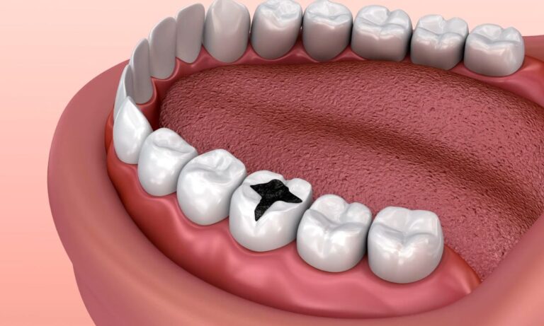ilustrovani prikaz karijesa na zubu