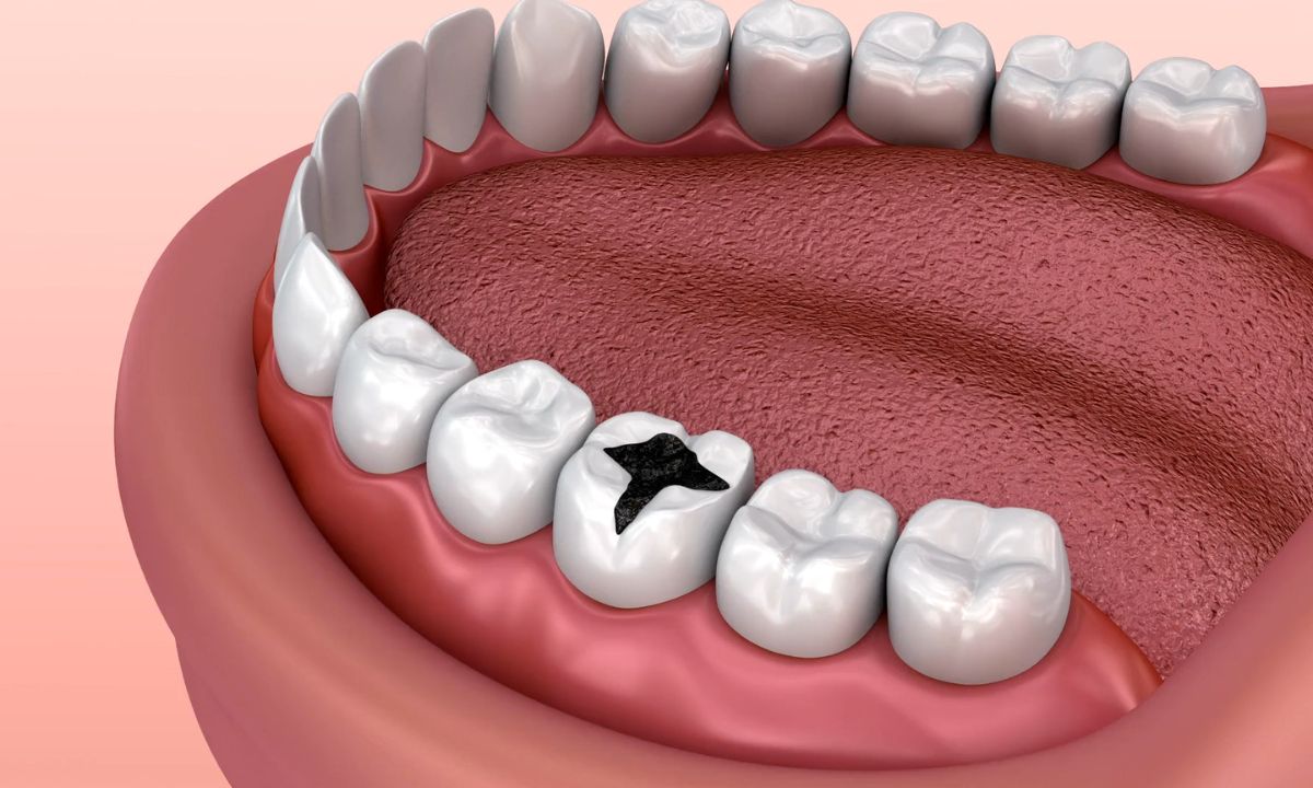 ilustrovani prikaz karijesa na zubu