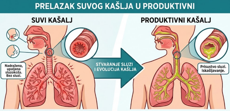 Prelazak suvog kašlja u produktivni - ilustracija